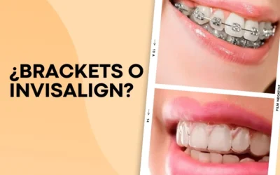 Diferencias entre Ortodoncia Tradicional con Brackets  e Invisalign Una Guía Informativa